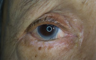 Ectropion ed Entropion