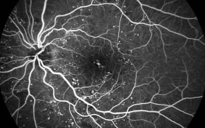 Retinopatia Diabetica