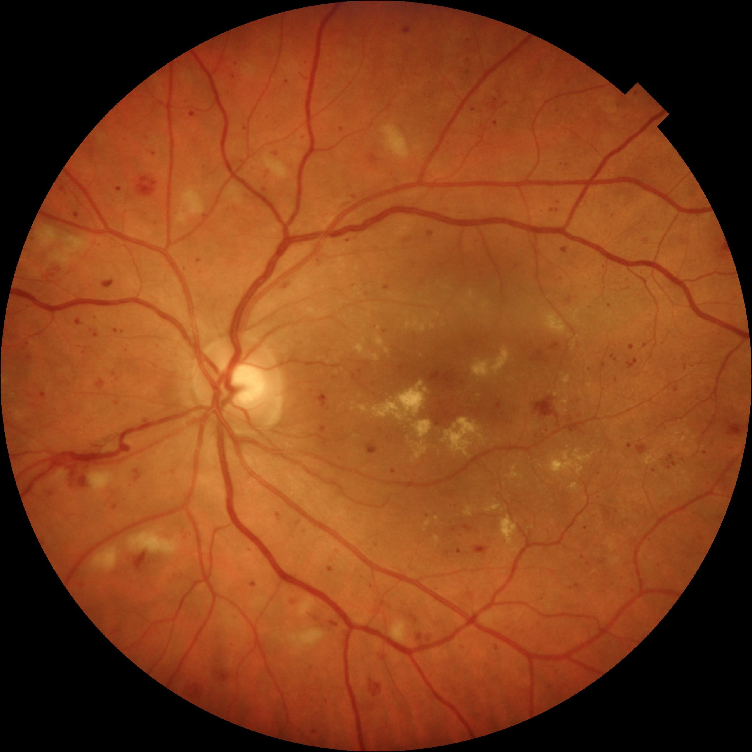 DIAGNOSI CON ANGIO-OCT E TRATTAMENTO CON LASER SOTTOSOGLIA