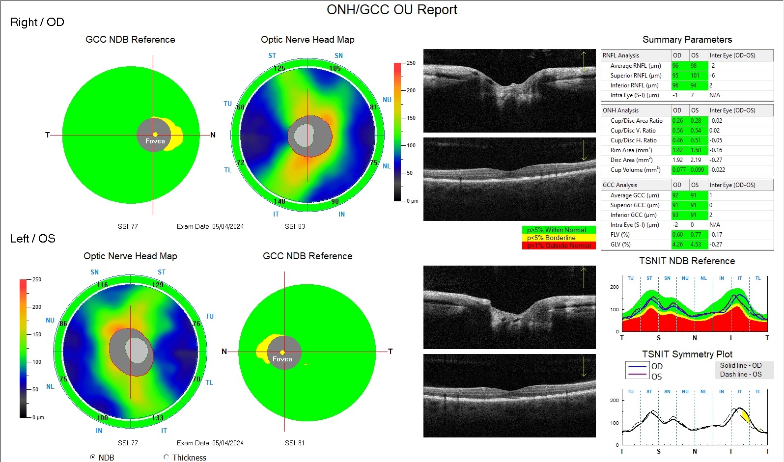GLAUCOMA AD ANGOLO APERTO