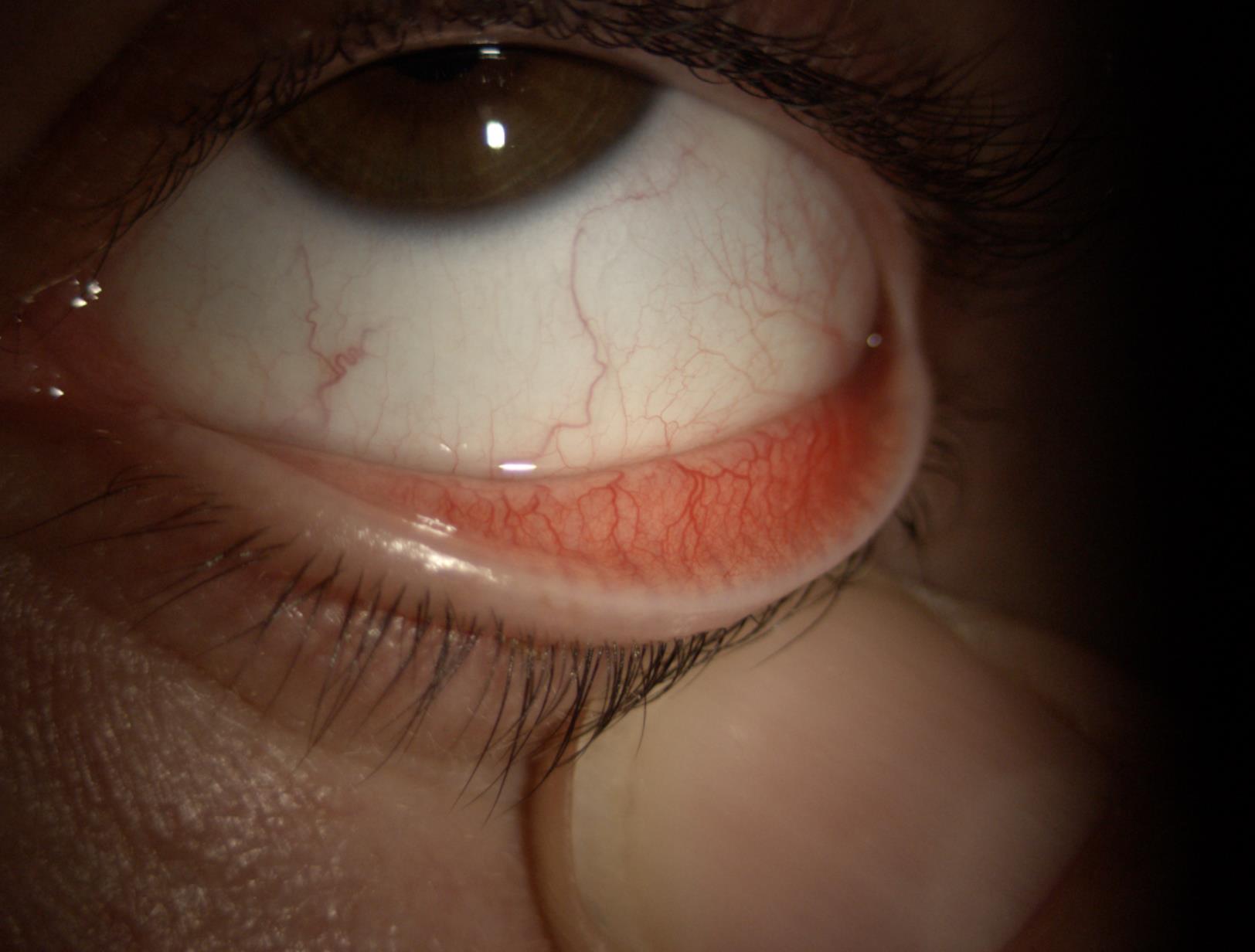 SINDROME DELL'OCCHIO SECCO: LA FISIOPATOLOGIA