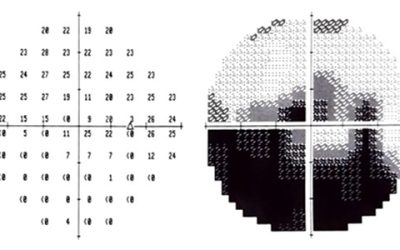 Glaucoma